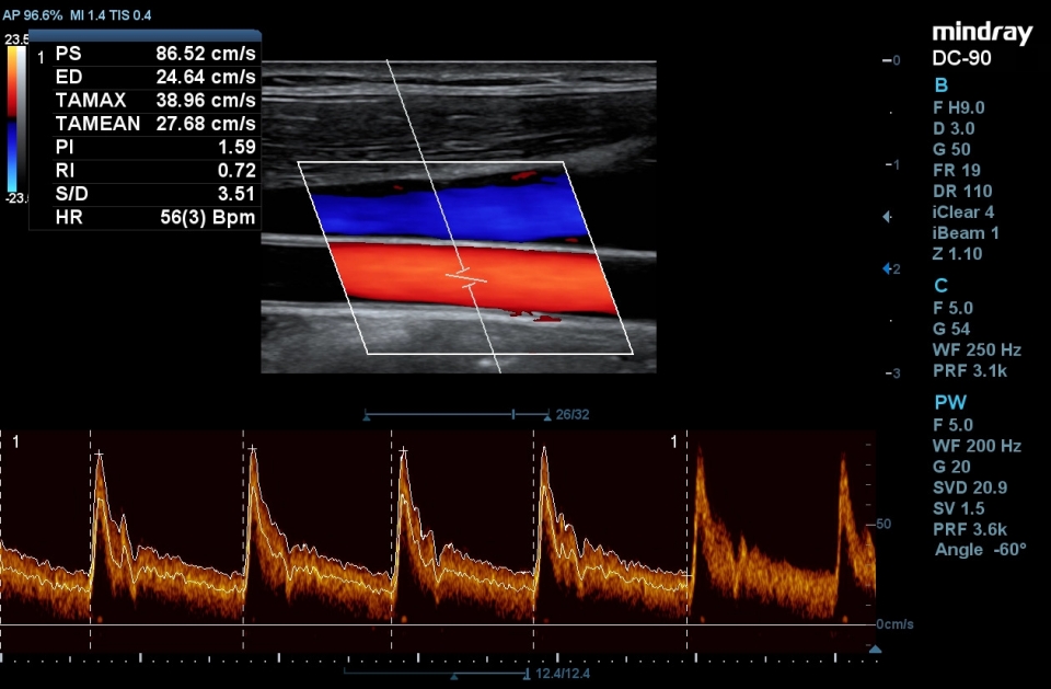Mindray DC-90 X-insight