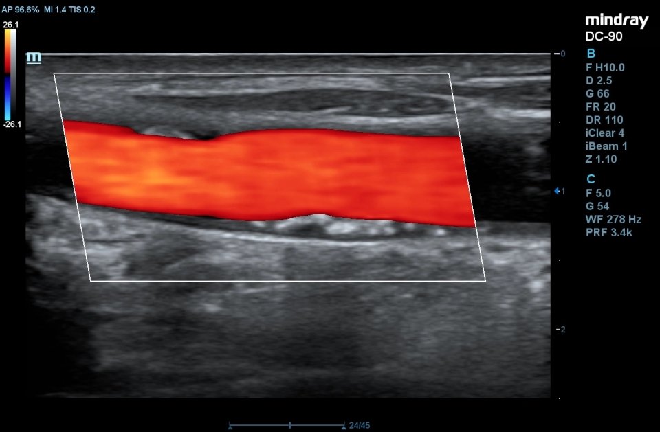 Mindray DC-90 X-insight
