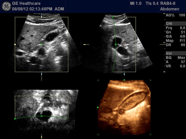 GE Logiq S7 с XDClear