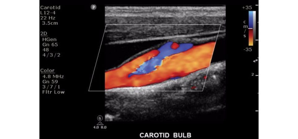 Philips ClearVue 550